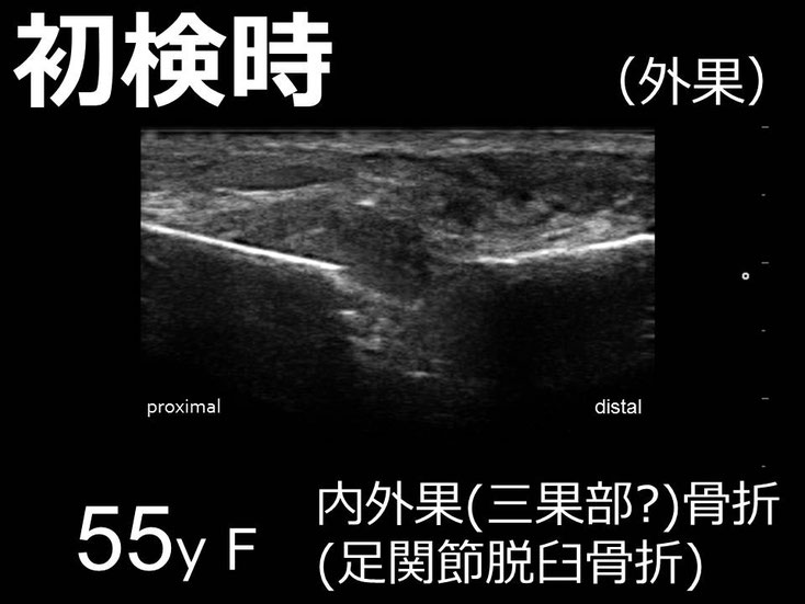 右足関節脱臼骨折 接骨院 豊田市 骨折 脱臼 スポーツ外傷 交通事故