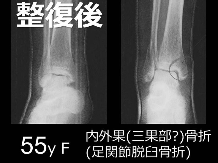 豊田市　おおつか接骨院　右足関節脱臼骨折　レントゲン　初診