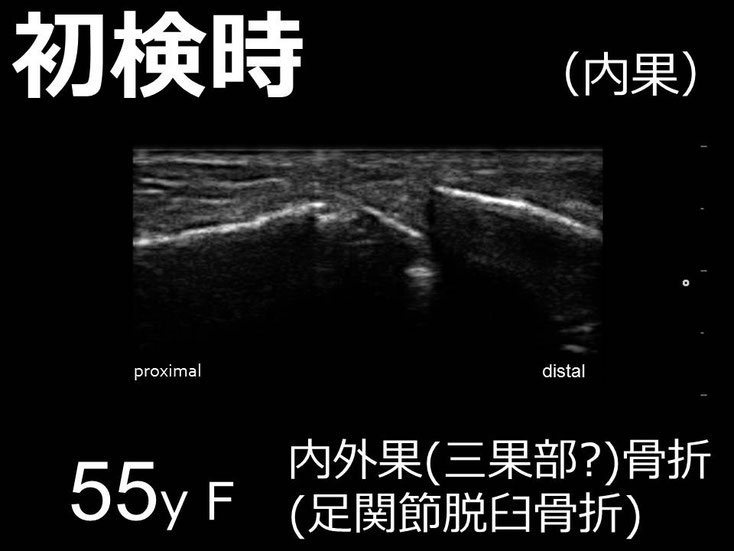 豊田市 おおつか接骨院 右足関節脱臼骨折 超音波画像 内果