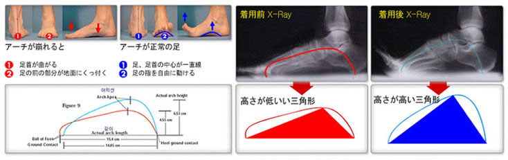 使用前後のアーチ状態比較