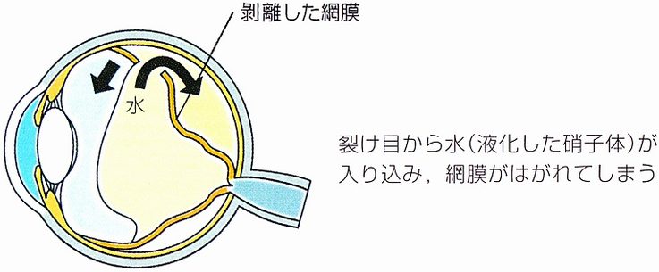 網膜剥離とは、網膜が剥がれてしまう目の病気です。