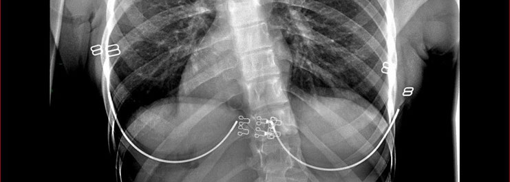 X-ray showing Scoliosis
