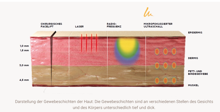Wirktiefe für SMAS Wirkung Ultherapy PRIME