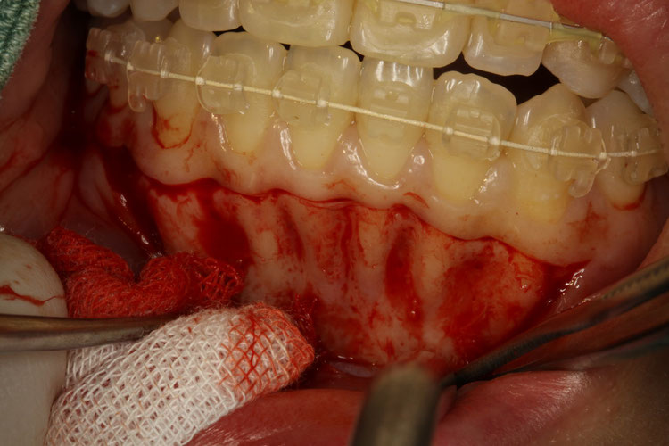 矯正中に歯茎が下がる