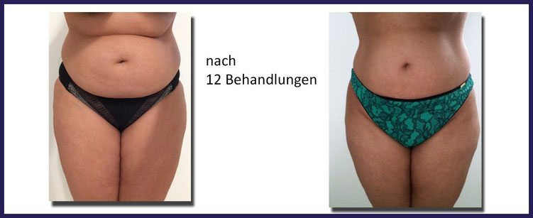 Brazilian photos before wax and after Brazilian photos before wax and after