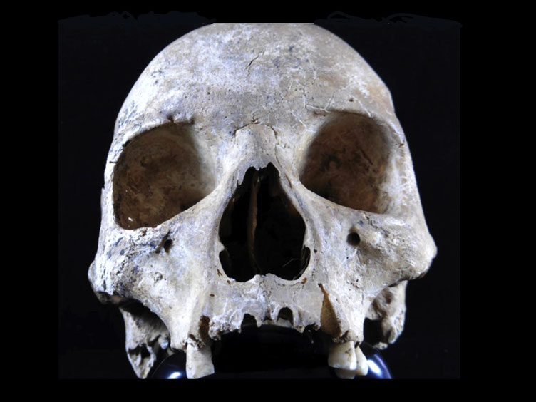 Leprosy infected woman's skull medieval England