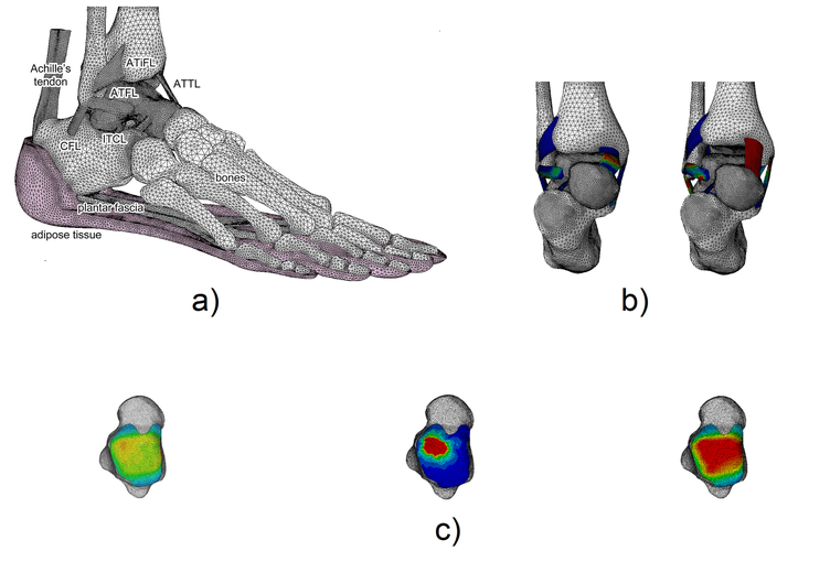 Finite element model of the foot, pointing out adipose tissue region (a). Finite element analysis of ankle joint (b) in plantarflexion and dorsiflexion conditions. Response of cartilage in damaged condition because of arthritic degradation (c).