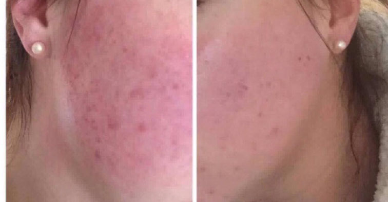 Before and after Glow Peel, Acne treatment, Rosacea treatment, Skin Clinic Neath