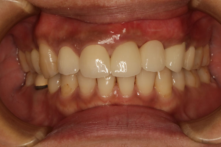 歯茎の再生　６２　長くなったオールセラミックブリッジ審美治療
