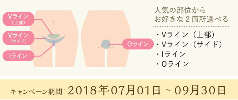 痛くない吉祥寺の脱毛サロン Dione吉祥寺本店 期間限定キャンペーン VIOの部位表
