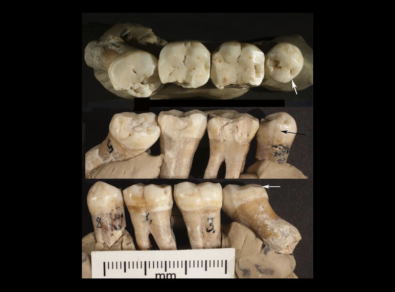 neanderthal dentistry toothpick teeth