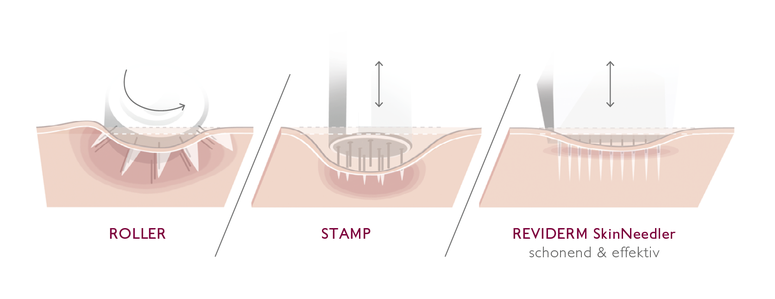 Grafik zum Vergleich von Microneedling-Roller, Stempeltechnik und REVIDERM SkinNeedler für eine schonende Hautregeneration.