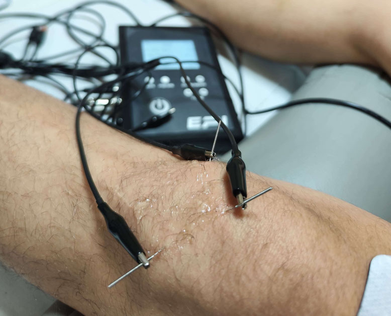 Tratamiento EPI tendinitis