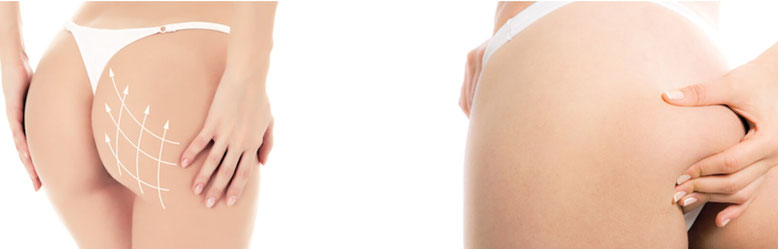 hifu gluteos