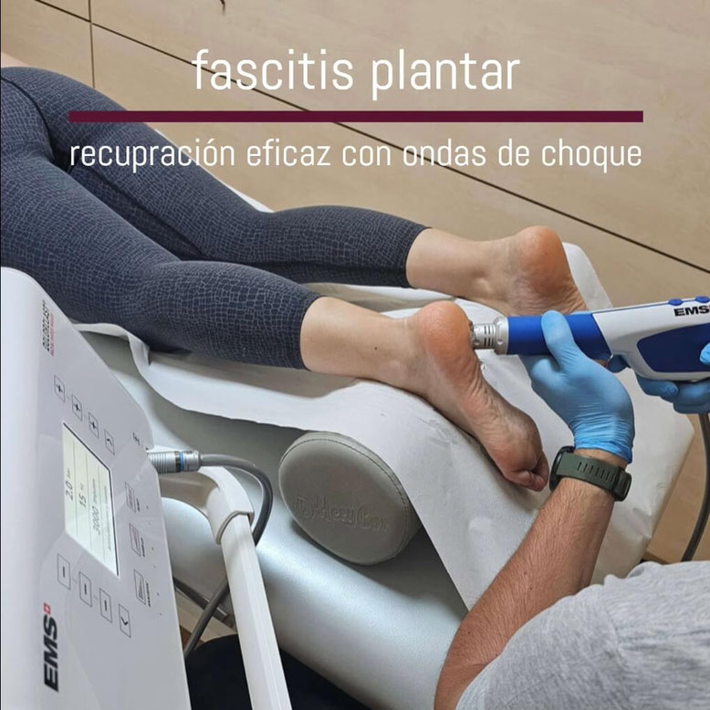 Ondas de choque fascitis plantar