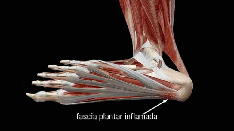 fascitis plantar fisioterapia