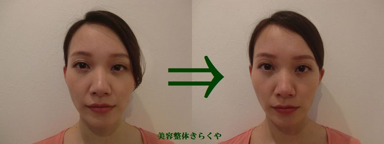 (結果には個人差があります。施術6回・期間2ヶ月)