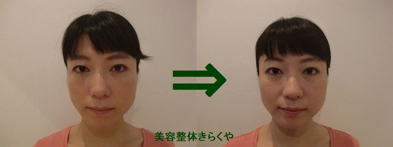(結果には個人差があります。施術6回・期間2ヶ月)