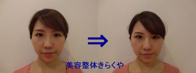 (結果には個人差があります。施術6回・期間2ヶ月)