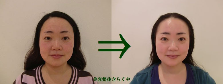 (結果には個人差があります。施術6回・期間2ヶ月)