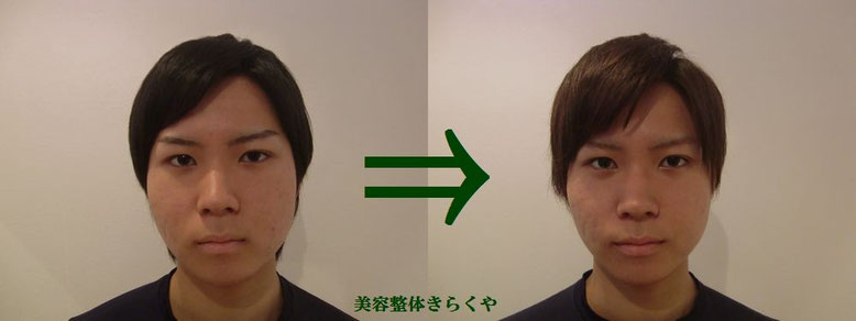(結果には個人差があります。施術6回・期間2ヶ月)