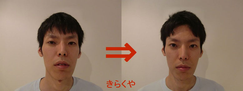(結果には個人差があります。施術6回・期間2ヶ月)