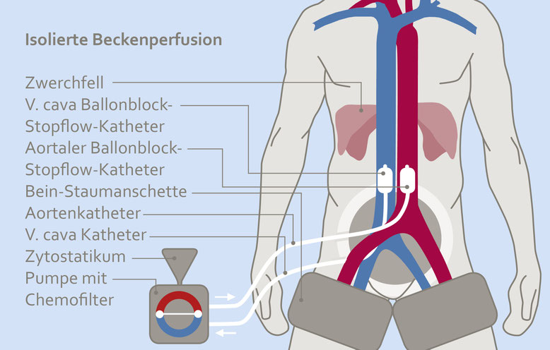 Schematische Darstellung der isolierten Beckenperfusion: Menschlicher Oberkörper mit markierten Blutgefäßen, Kathetern und angeschlossener Pumpe mit Chemofilter.