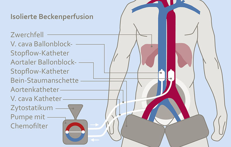 Schematische Darstellung der isolierten Beckenperfusion: Menschlicher Oberkörper mit markierten Blutgefäßen, Kathetern und angeschlossener Pumpe mit Chemofilter.