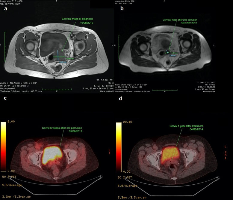 MRT- und PET-CT-Bildaufnahmen einer Patientin mit fortgeschrittenem Zervixkarzinom vor und nach HPP-Behandlung, zeigend Tumorverkleinerung und vollständige metabolische Remission über ein Jahr.