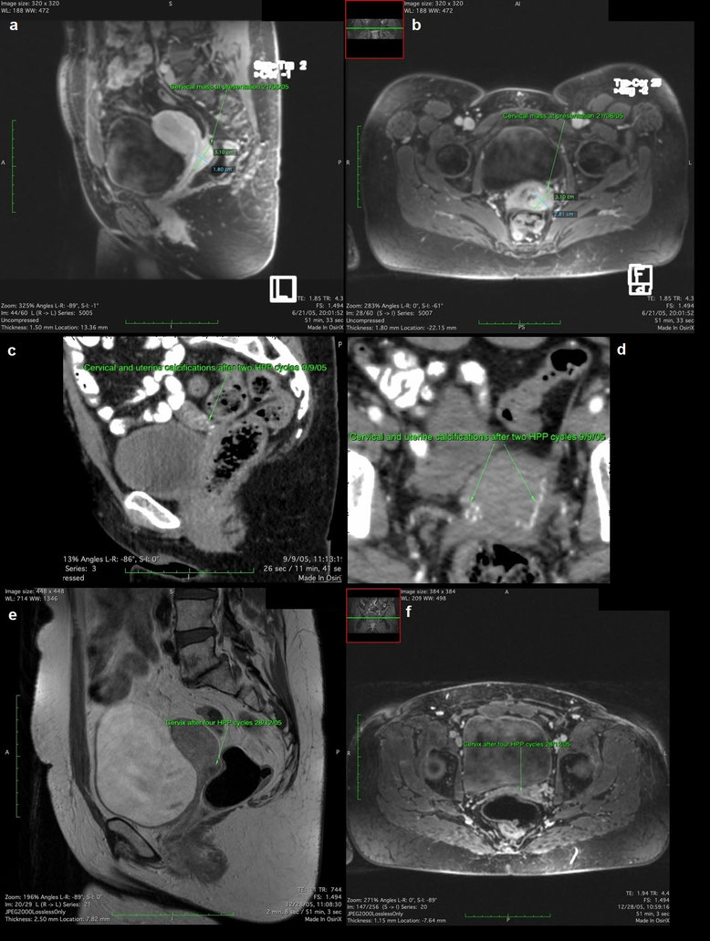 Mehrere MRT- und CT-Aufnahmen einer Patientin mit fortgeschrittenem Zervixkarzinom vor und nach Behandlung mit mehreren HPP-Zyklen, dokumentierend die Tumorverkalkung, Tumornekrose und Therapieansprechen.
