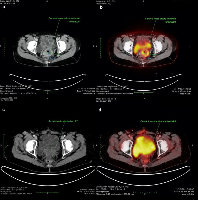CT- und PET-CT-Aufnahmen einer Patientin mit Zervixkarzinom vor und nach HPP-Behandlung, zeigend Tumorreduktion und fehlende metabolische Aktivität drei Monate nach Therapieabschluss.