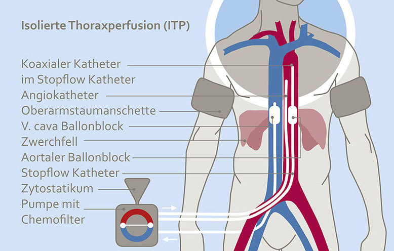 Schematische Darstellung der isolierten Thoraxperfusion (ITP): Menschlicher Oberkörper mit markierten Blutgefäßen, Kathetern, Staumanschetten und externer Pumpe mit Chemofilter.