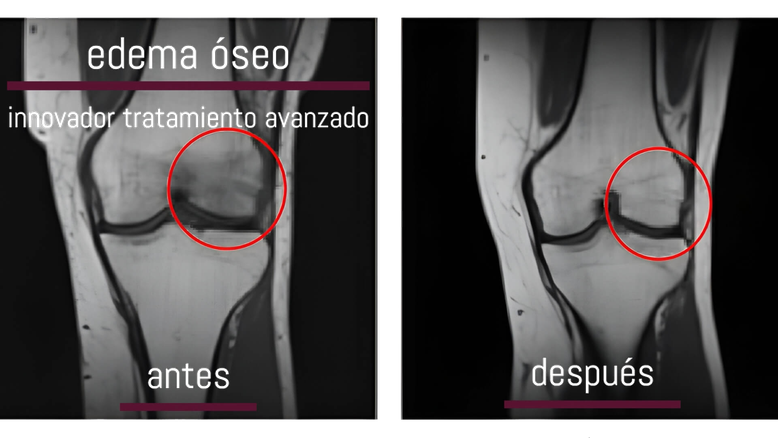 Edema óseo. Antes y después del tratamiento