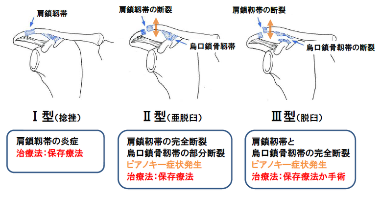 肩鎖関節脱臼　肩の痛み