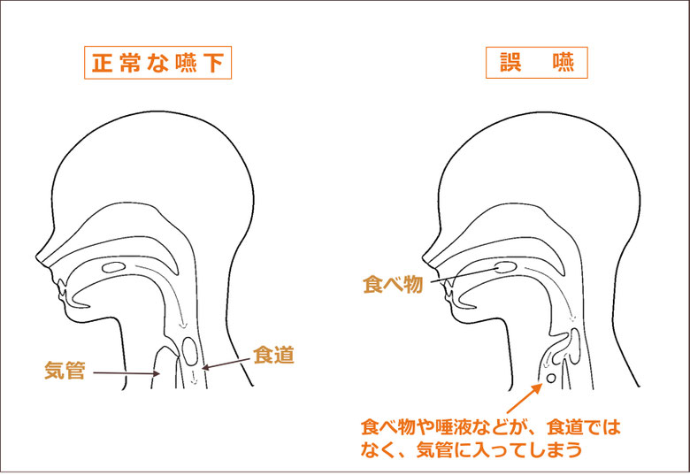 「正常な嚥下と誤嚥(ごえん)」