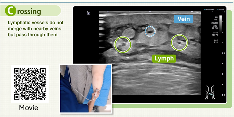 Lymphatic Ultrasound for lymphedema