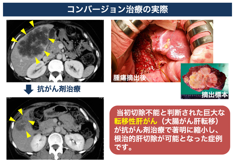 福岡での肝臓がん手術はこちらへ - 福岡大学 消化器外科
