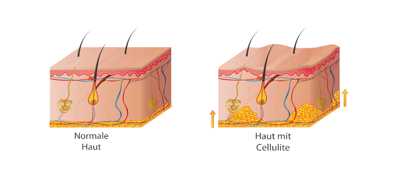 Cellulite-Behandlung, normale Haut, Haut mit Cellulite.