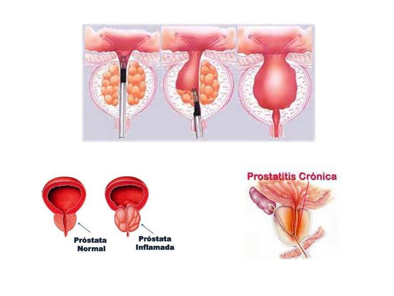 un virus puede causar prostatitis