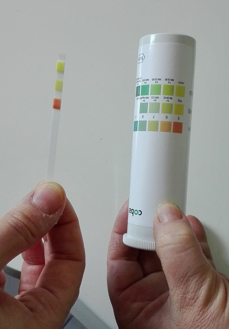 Checking urine with a urine testing stick.
