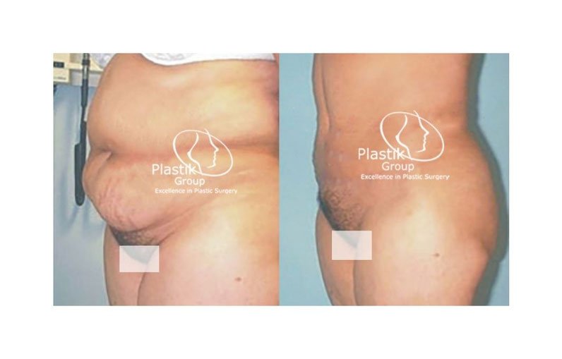 abdominoplastia  zapopan