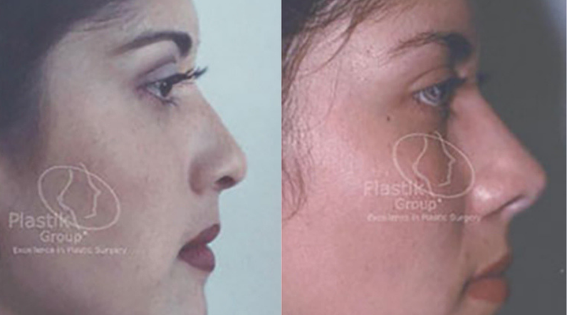 Rinoplastia o cirugía de nariz Jalisco