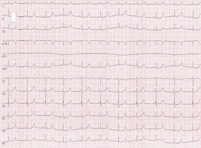 EKG Langes QT-Syndrom LQT1 