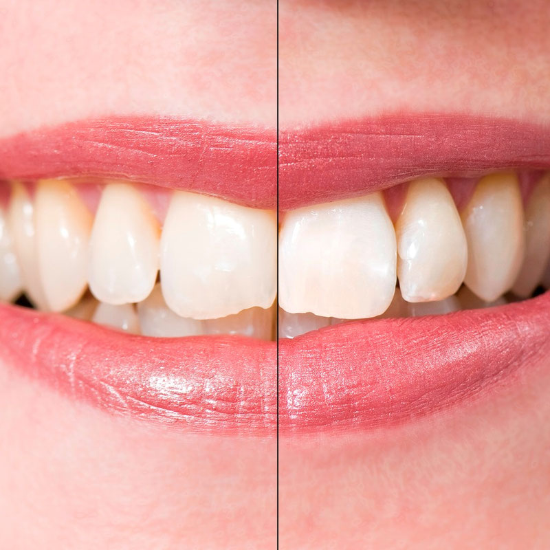 Schöne weiße Zähne durch professionelle Zahnaufhellung - zahnarzt-dr-fleischmanns Jimdo-Page!