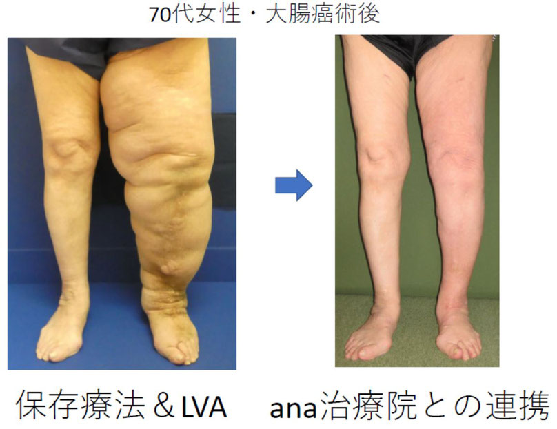 大腸がん　リンパ浮腫　日帰りLVA手術　保存療法　三原誠　蜂窩織炎　手術　治療　名医　専門医