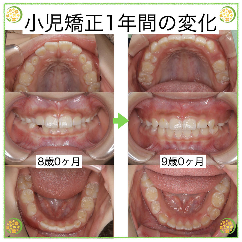 やみか歯科・矯正歯科　小児矯正　子どもの矯正　子どもの出っ歯治療