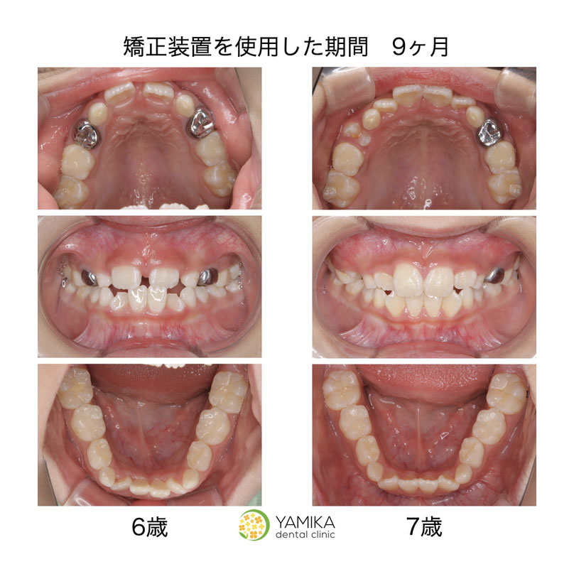 やみか歯科・矯正歯科 小児矯正 子どもの矯正いつ始める 子どもの矯正様子をみる