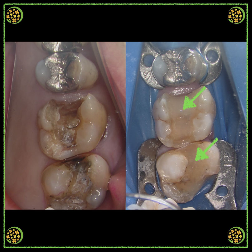 やみか歯科・矯正歯科　二次虫歯予防　精密歯科治療　歯の裏層