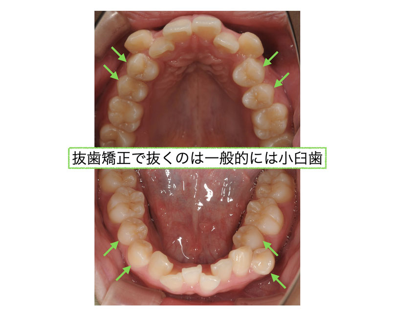 抜歯矯正はどの歯を抜く？ - 新大阪の歯医者｜やみか歯科・矯正歯科