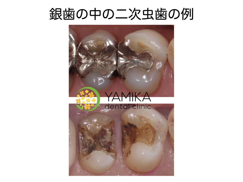 やみか歯科・矯正歯科　銀歯　二次虫歯